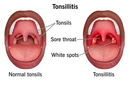 Tonsillitis