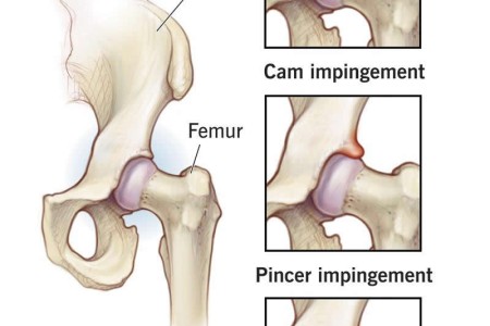 Hip Impingement (Femoroacetabular Impingement or FAI)