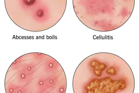 Staph Infection