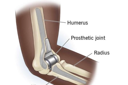 Elbow Replacement