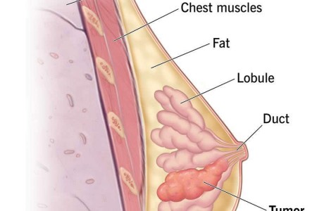 Invasive Lobular Carcinoma (ILC)