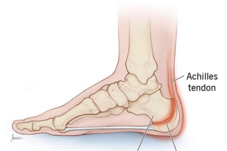 Sever’s Disease (Calcaneal Apophysitis)
