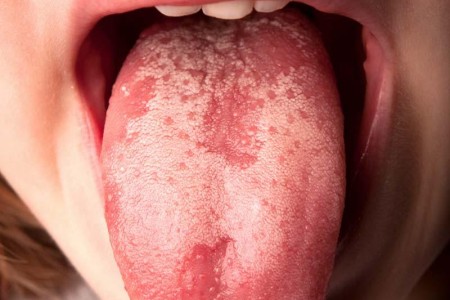 Geographic Tongue