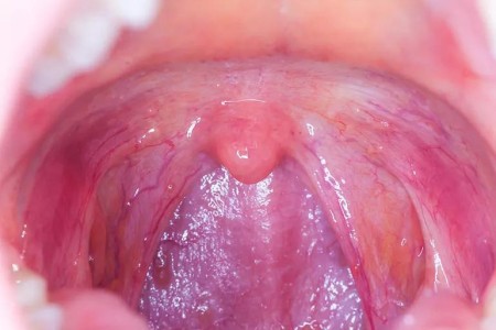 Throat Cancer’s Link to Oral Sex: What You Should Know