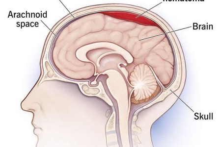 Subdural Hematoma