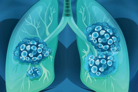 What Are the Chances a Lung Nodule or Spot Is Cancer?