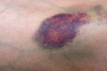 Do You Bruise Easily? When to Get It Checked Out