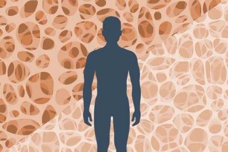Men: Don’t Let Osteoporosis Weaken Your Bones