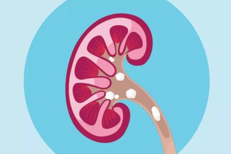 Why Do More People Get Kidney Stones in the Summer?