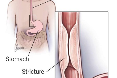 Esophageal Strictures