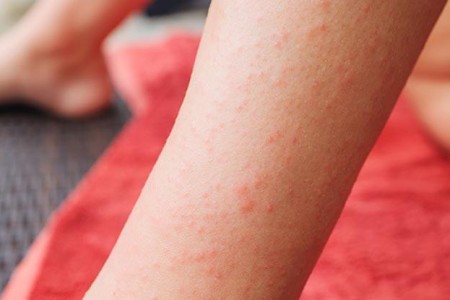 Dermatitis Herpetiformis