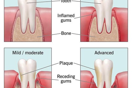 Periodontal Disease (Gum Disease)
