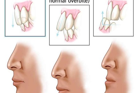 Overbite