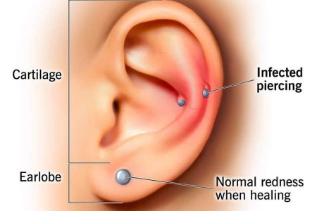 Infected Ear Piercing