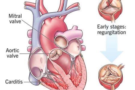 Rheumatic Heart Disease