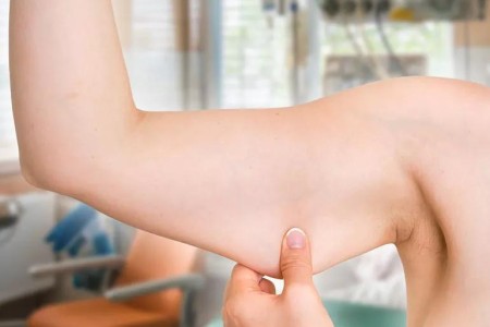 Thinking About Arm Lift Surgery? Facts You Should Know