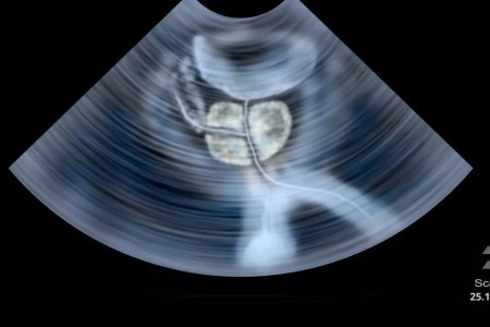 Can Ultrasound Help You Fight Prostate Cancer — and Avoid Surgery?
