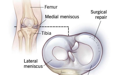 Meniscus Surgery