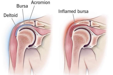 Shoulder Bursitis