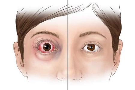 Proptosis (Bulging Eyes)