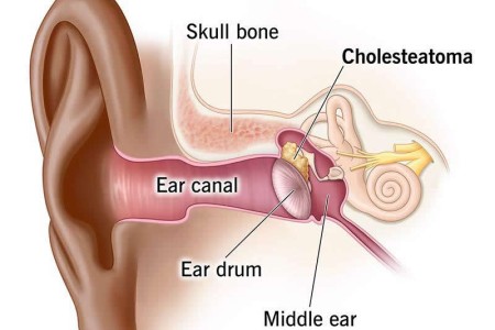 Cholesteatoma