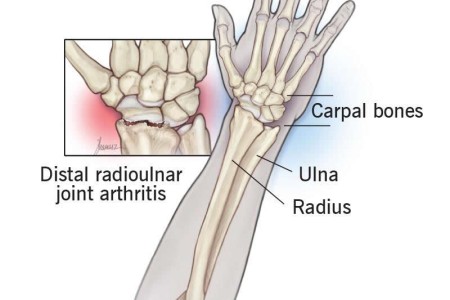 Arthritis in Wrist