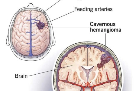 Cavernous Malformation (Cavernoma)