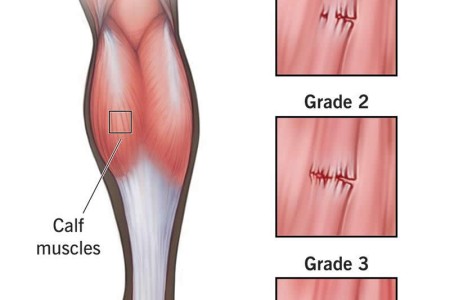 Calf Strain (Pulled Calf Muscle)