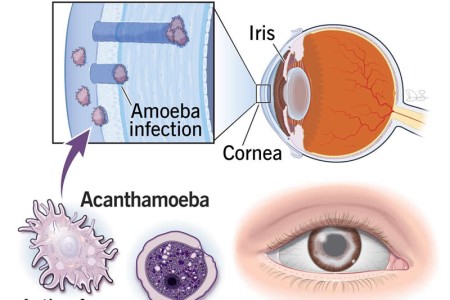 Acanthamoeba Keratitis