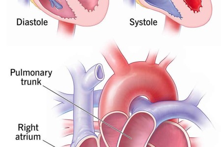 Tricuspid Valve Regurgitation