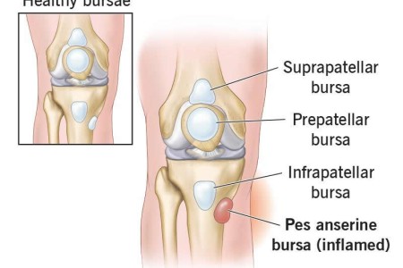 Pes Anserine Bursitis