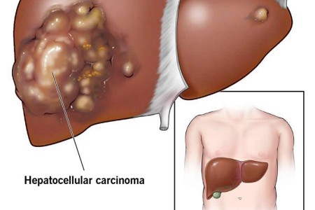 Hepatocellular Carcinoma (HCC)