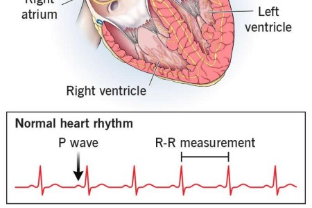 Premature Atrial Contractions