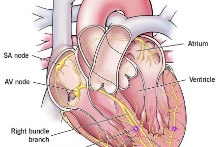 Right Bundle Branch Block