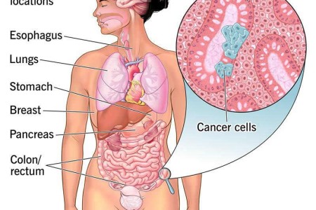 Adenocarcinoma Cancers