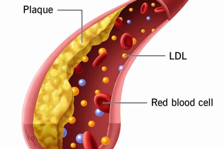 Hyperlipidemia