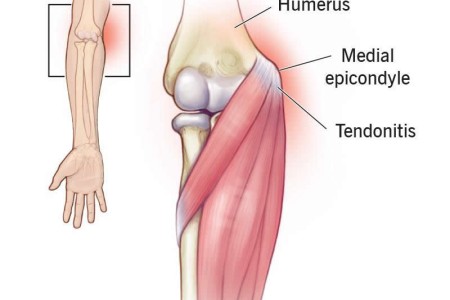 Golfer’s Elbow (Medial Epicondylitis)
