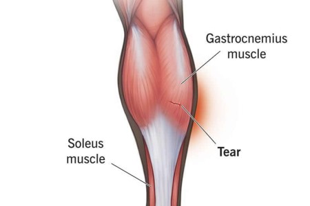 Torn Calf Muscle