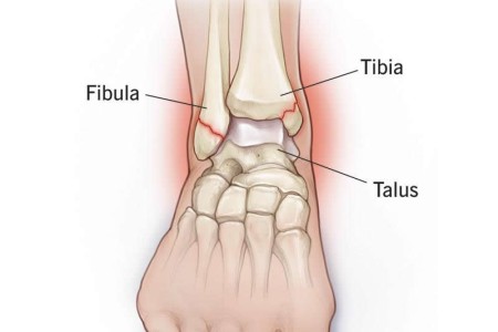 Broken Ankle (Fractured Ankle)
