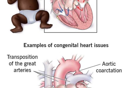 Congenital Heart Disease