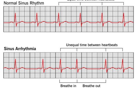 Sinus Arrhythmia