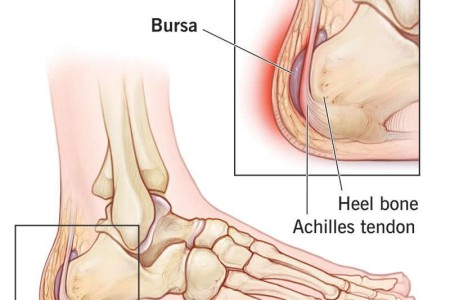 Heel Bursitis