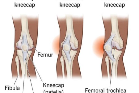 Dislocated Kneecap (Patella Dislocation)