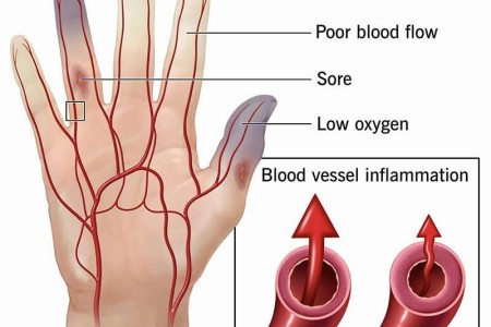 Buerger’s Disease