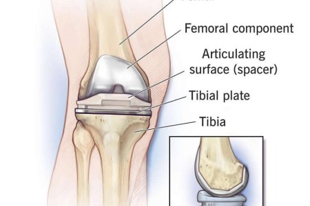 Arthroplasty (Joint Replacement)