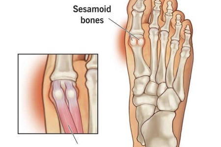 Sesamoiditis
