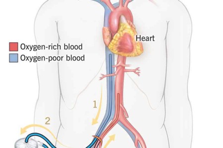 ECMO