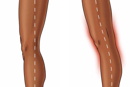 Joint Hypermobility Syndrome