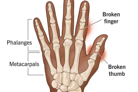 Broken Finger or Thumb