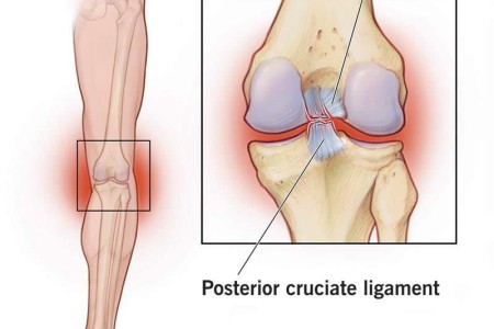 Posterior Cruciate Ligament (PCL) Injury